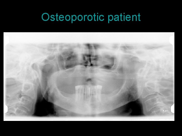 Osteoporotic patient 