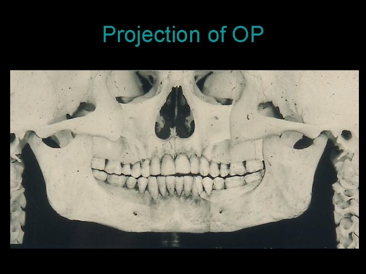 Projection of OP 