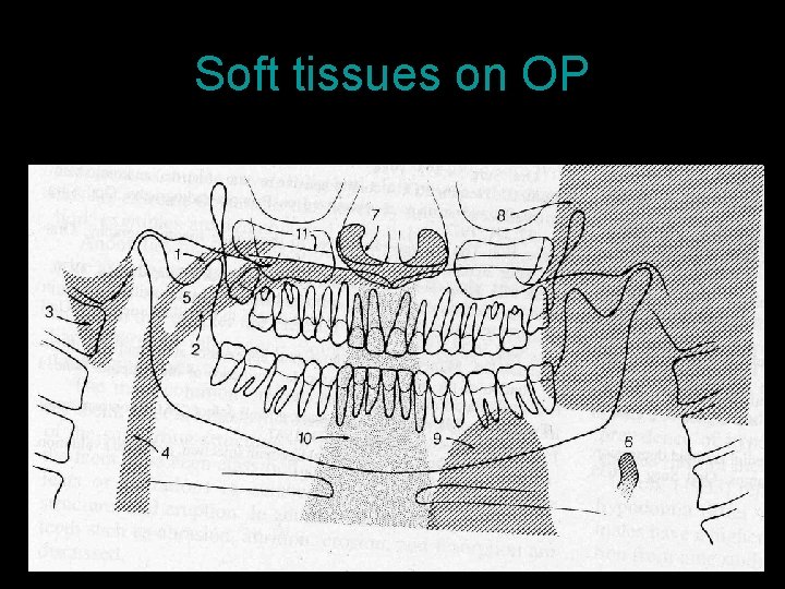 Soft tissues on OP 