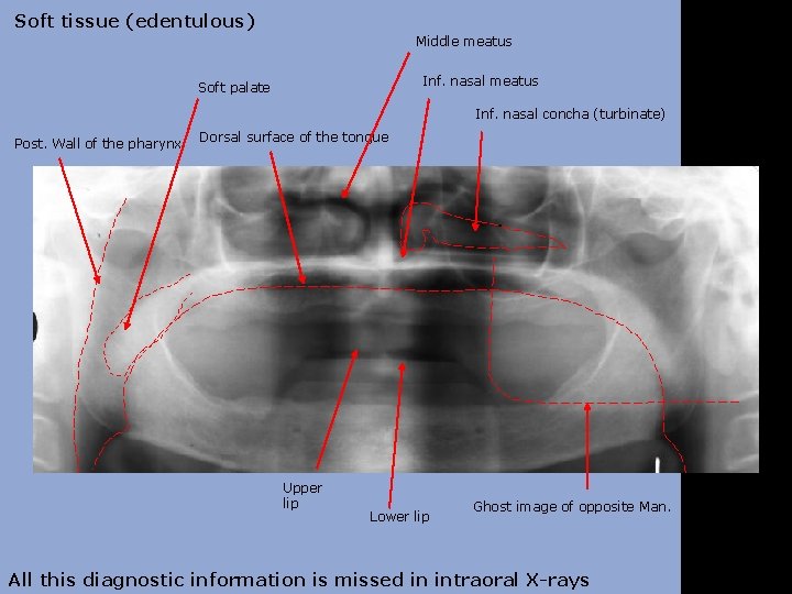 Soft tissue (edentulous) Middle meatus Inf. nasal meatus Soft palate Inf. nasal concha (turbinate)