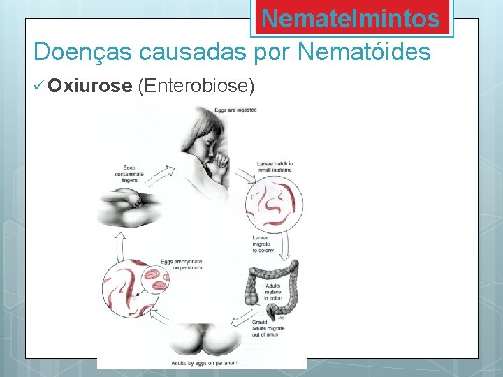 Nematelmintos Doenças causadas por Nematóides ü Oxiurose (Enterobiose) 