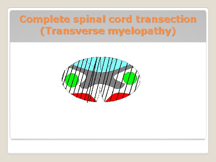 Complete spinal cord transection (Transverse myelopathy) 