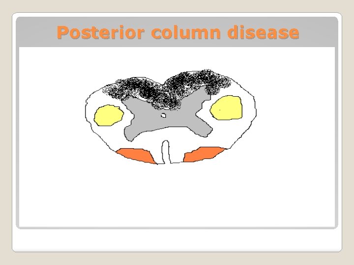 Posterior column disease 