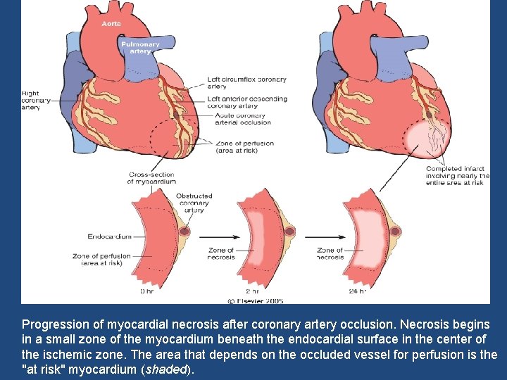 Progression of myocardial necrosis after coronary artery occlusion. Necrosis begins in a small zone