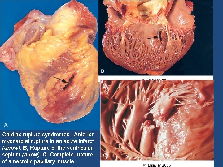 Cardiac rupture syndromes : Anterior myocardial rupture in an acute infarct (arrow). B, Rupture