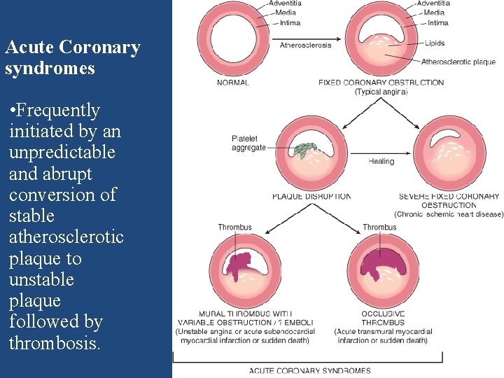 Acute Coronary syndromes • Frequently initiated by an unpredictable and abrupt conversion of stable