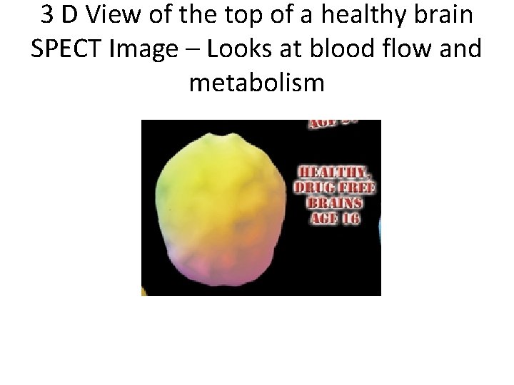 3 D View of the top of a healthy brain SPECT Image – Looks