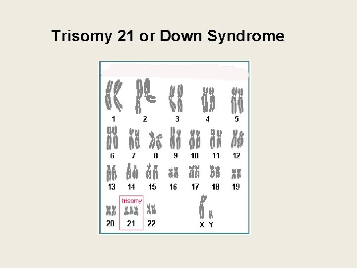 Trisomy 21 or Down Syndrome 