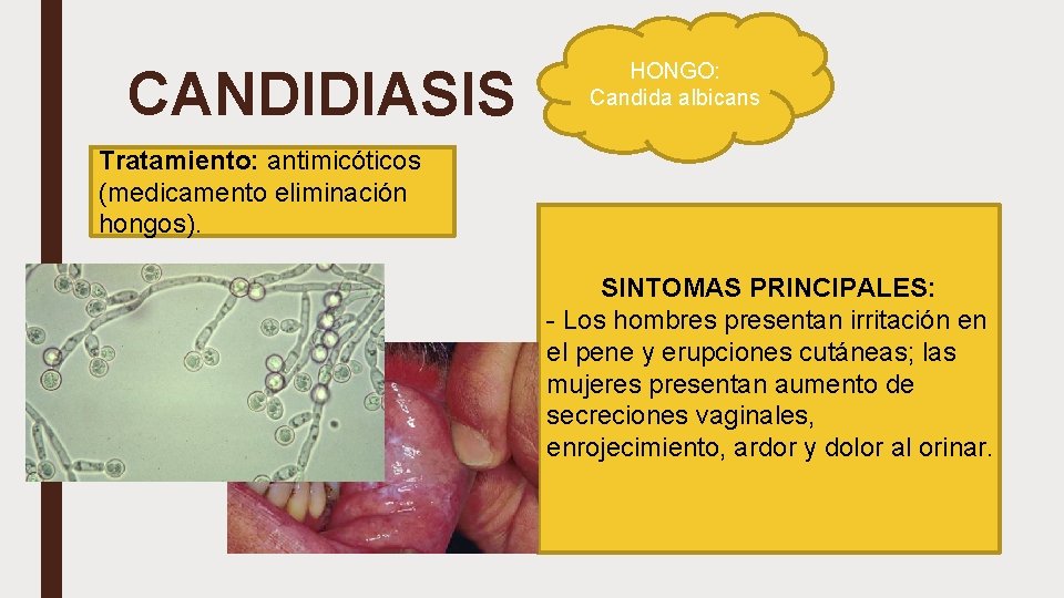 CANDIDIASIS HONGO: Candida albicans Tratamiento: antimicóticos (medicamento eliminación hongos). SINTOMAS PRINCIPALES: - Los hombres