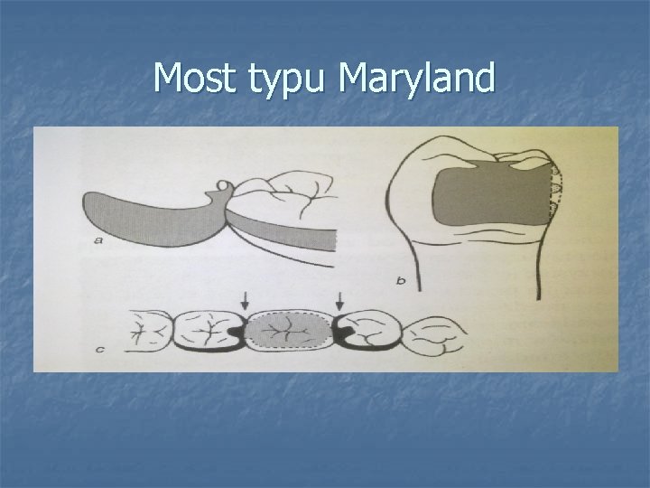 Most typu Maryland 