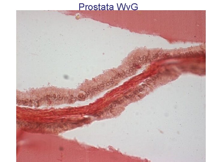 Prostata Wv. G 