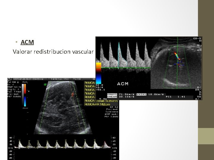  • ACM Valorar redistribucion vascular 