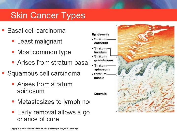 Skin Cancer Types § Basal cell carcinoma § Least malignant § Most common type