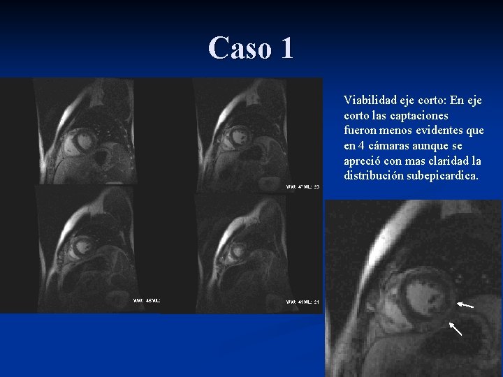 Caso 1 Viabilidad eje corto: En eje corto las captaciones fueron menos evidentes que