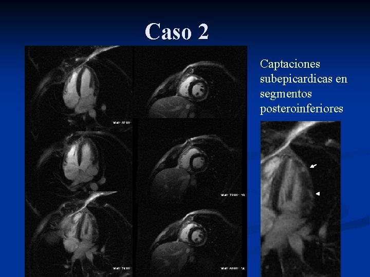 Caso 2 Captaciones subepicardicas en segmentos posteroinferiores 