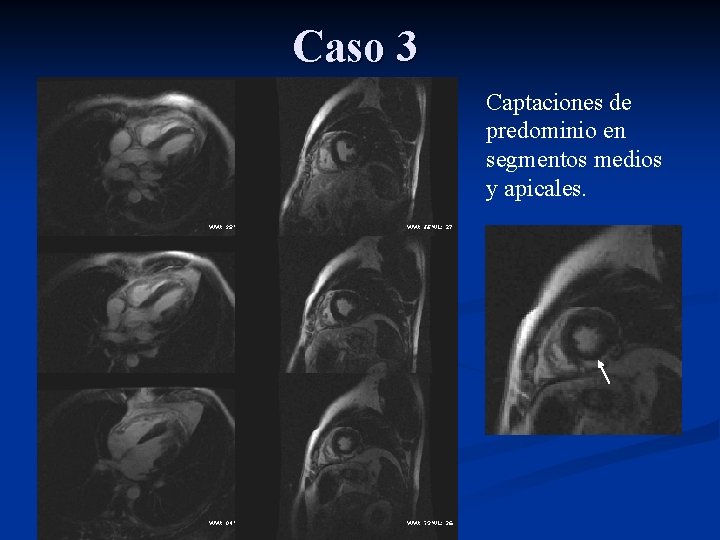 Caso 3 Captaciones de predominio en segmentos medios y apicales. 