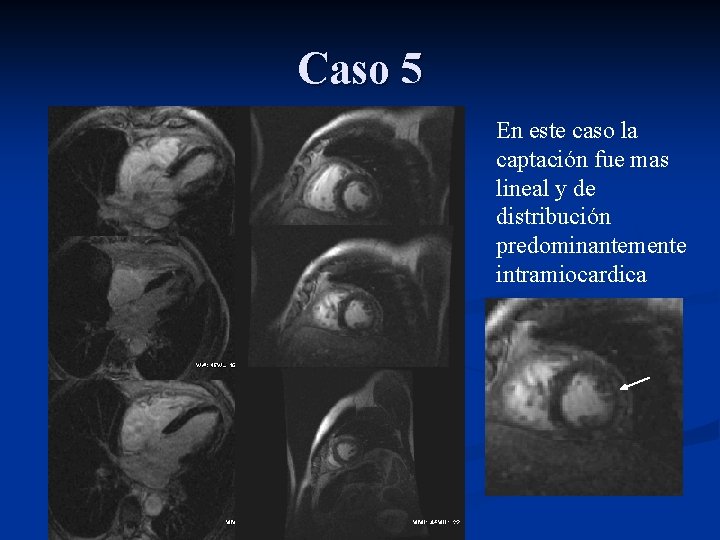 Caso 5 En este caso la captación fue mas lineal y de distribución predominantemente