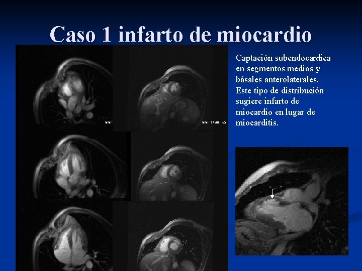 Caso 1 infarto de miocardio Captación subendocardica en segmentos medios y básales anterolaterales. Este