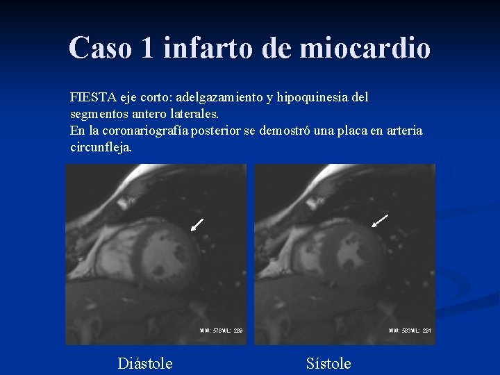 Caso 1 infarto de miocardio FIESTA eje corto: adelgazamiento y hipoquinesia del segmentos antero