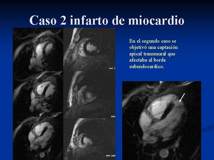 Caso 2 infarto de miocardio En el segundo caso se objetivó una captación apical