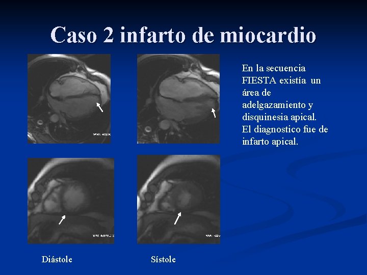 Caso 2 infarto de miocardio En la secuencia FIESTA existía un área de adelgazamiento