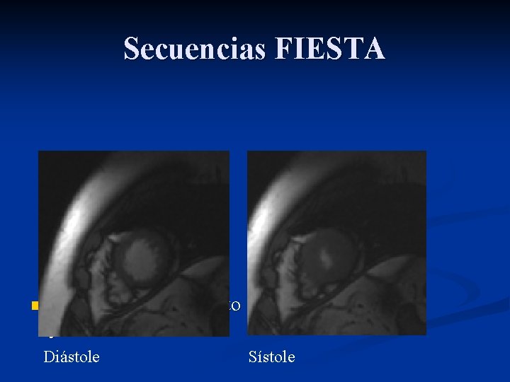 Secuencias FIESTA n Realizadas en ejes corto y 4 cámaras Diástole Sístole 