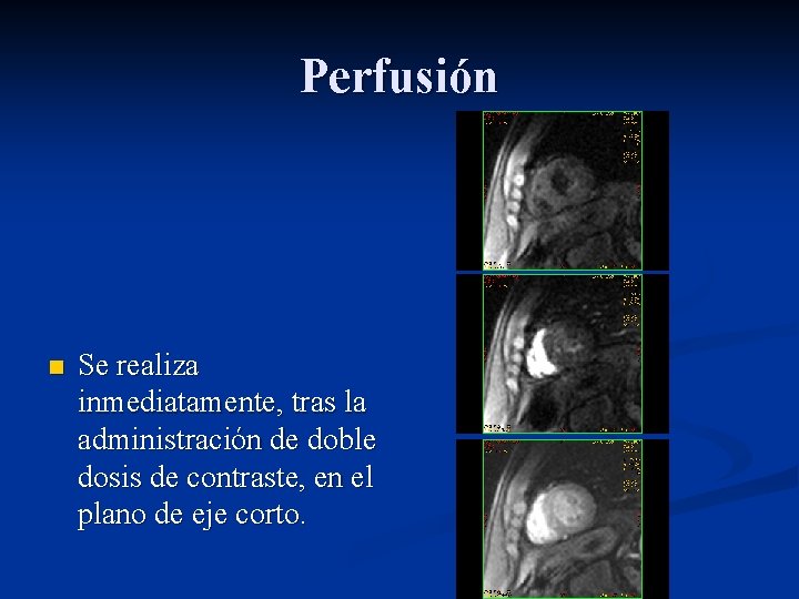 Perfusión n Se realiza inmediatamente, tras la administración de doble dosis de contraste, en