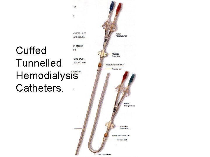 Cuffed Tunnelled Hemodialysis Catheters. 