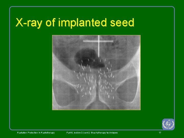 X-ray of implanted seed Radiation Protection in Radiotherapy Part 6, lecture 2 (cont. ):