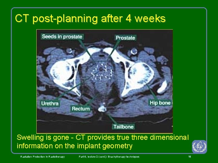 CT post-planning after 4 weeks Swelling is gone - CT provides true three dimensional