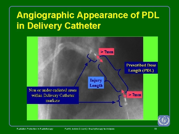 Angiographic Appearance of PDL in Delivery Catheter Radiation Protection in Radiotherapy Part 6, lecture