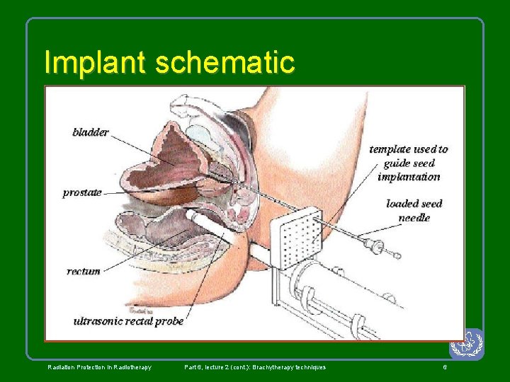 Implant schematic Radiation Protection in Radiotherapy Part 6, lecture 2 (cont. ): Brachytherapy techniques