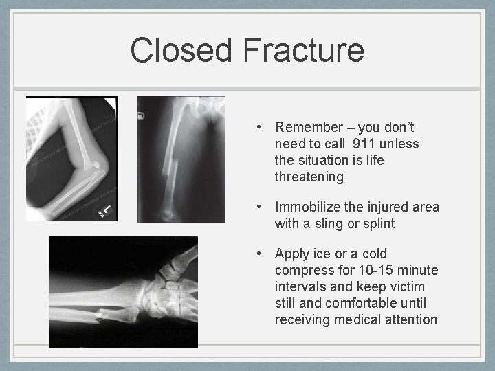 Closed Fracture • Remember – you don’t need to call 911 unless the situation