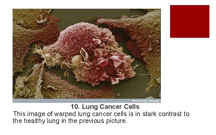 10. Lung Cancer Cells This image of warped lung cancer cells is in stark