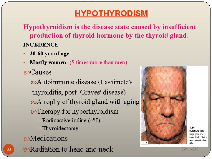 HYPOTHYRODISM Hypothyroidism is the disease state caused by insufficient production of thyroid hormone by