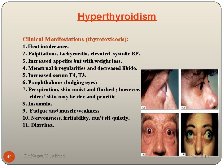 Hyperthyroidism Clinical Manifestations (thyrotoxicosis): 1. Heat intolerance. 2. Palpitations, tachycardia, elevated systolic BP. 3.