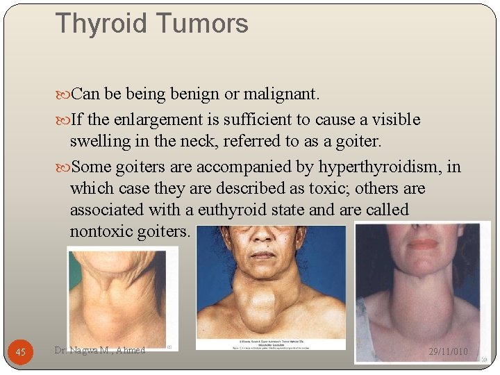 Thyroid Tumors Can be being benign or malignant. If the enlargement is sufficient to