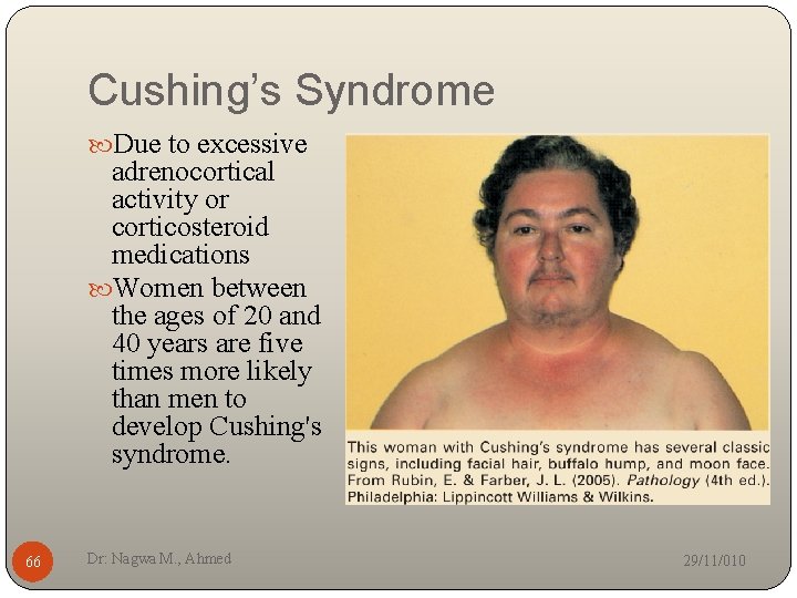 Cushing’s Syndrome Due to excessive adrenocortical activity or corticosteroid medications Women between the ages