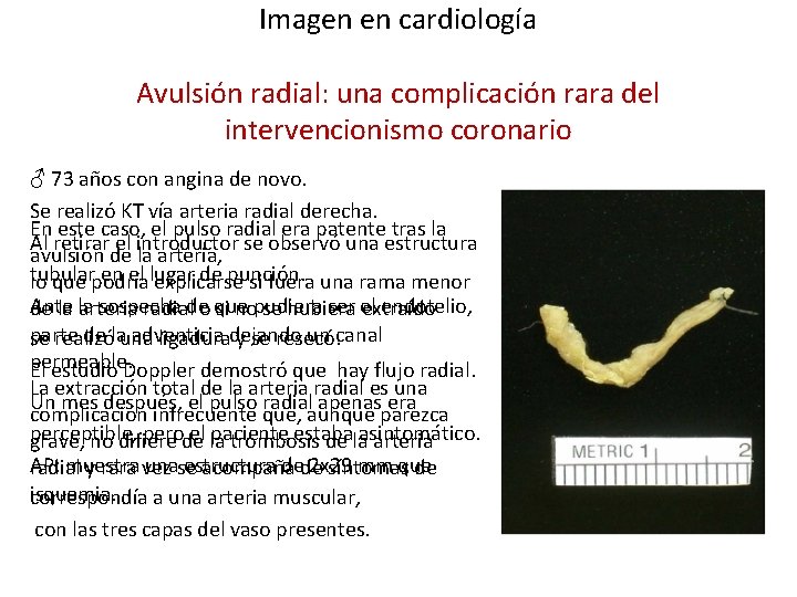 Imagen en cardiología Avulsión radial: una complicación rara del intervencionismo coronario ♂ 73 años