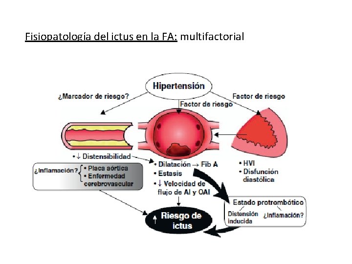 Fisiopatología del ictus en la FA: multifactorial 