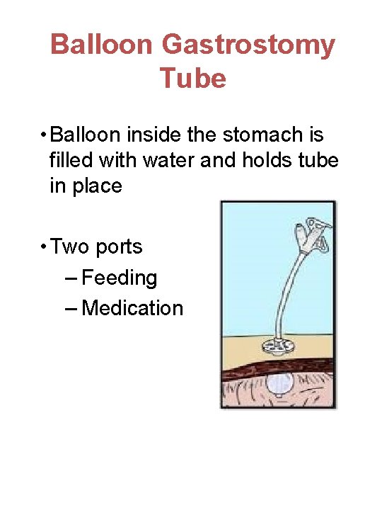 Balloon Gastrostomy Tube • Balloon inside the stomach is filled with water and holds