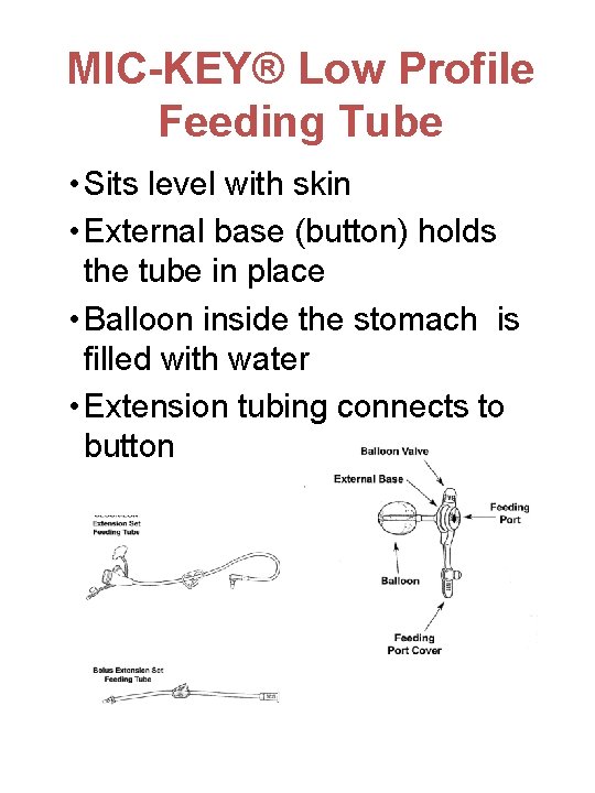 MIC-KEY® Low Profile Feeding Tube • Sits level with skin • External base (button)