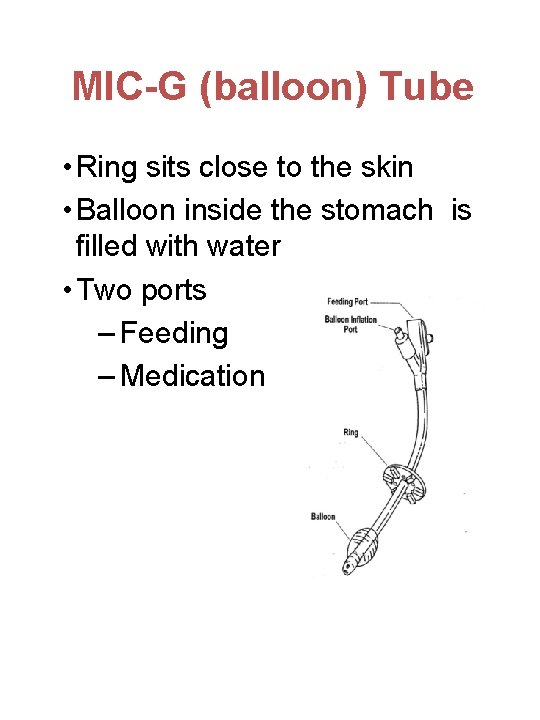 MIC-G (balloon) Tube • Ring sits close to the skin • Balloon inside the