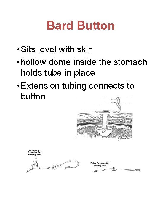 Bard Button • Sits level with skin • hollow dome inside the stomach holds