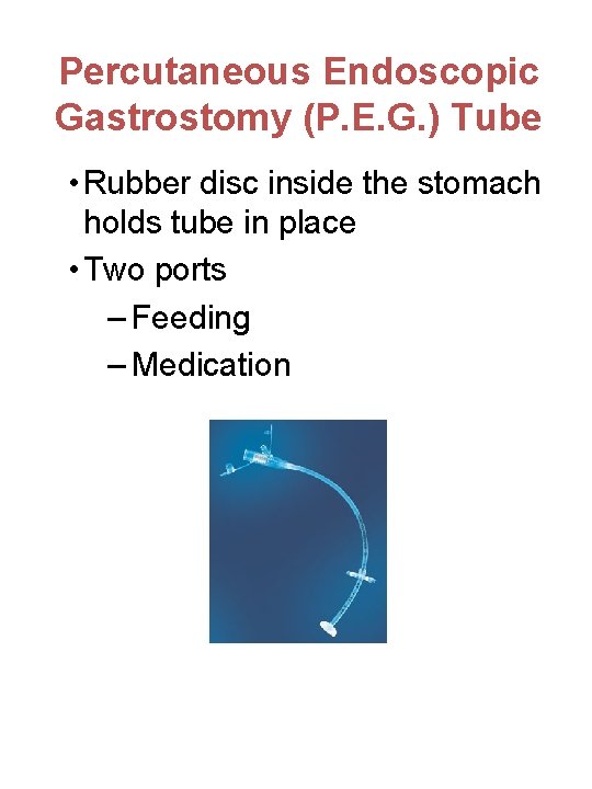 Percutaneous Endoscopic Gastrostomy (P. E. G. ) Tube • Rubber disc inside the stomach
