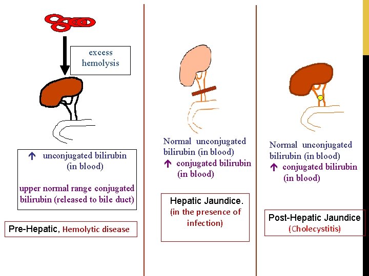 excess hemolysis unconjugated bilirubin (in blood) upper normal range conjugated bilirubin (released to bile