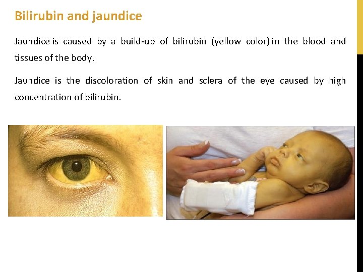 Bilirubin and jaundice Jaundice is caused by a build-up of bilirubin (yellow color) in