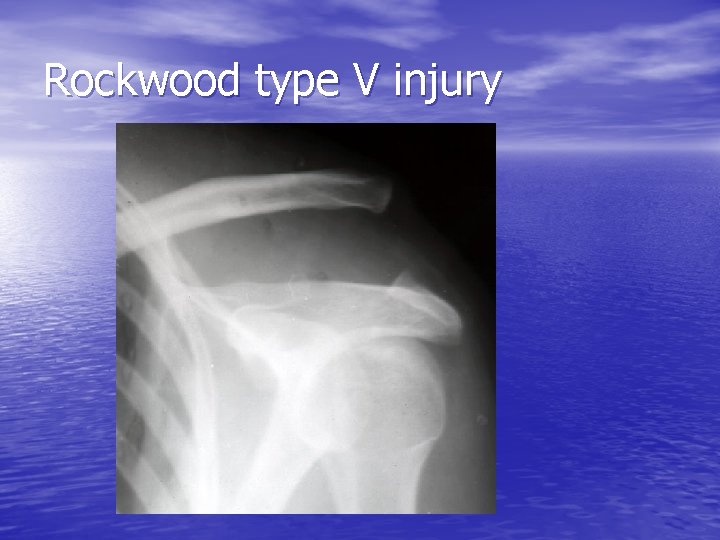 Rockwood type V injury 