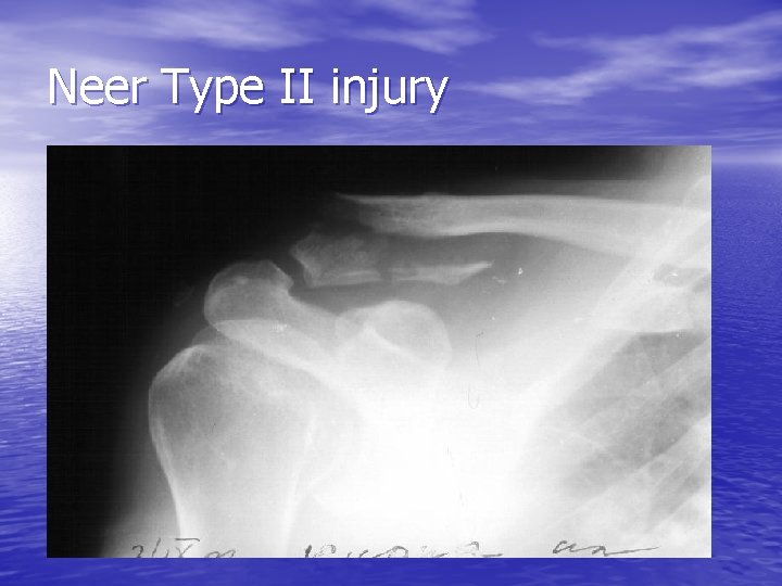 Neer Type II injury 