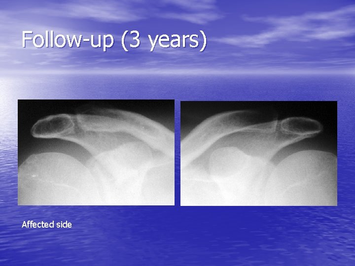 Follow-up (3 years) Affected side 